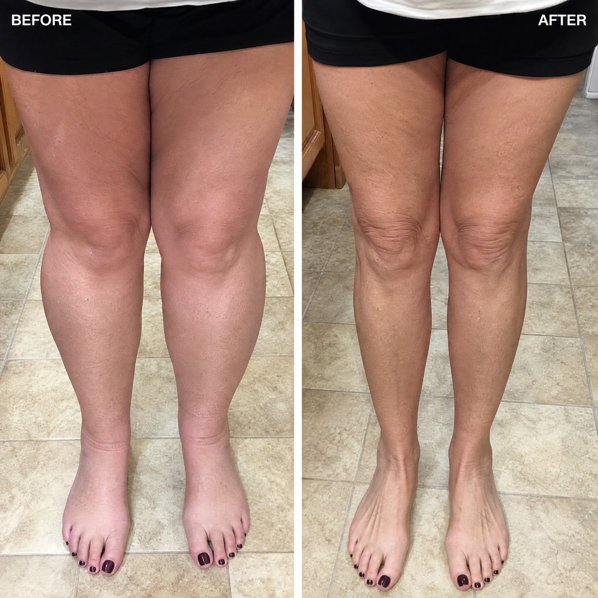 Before and after — slimmer, lighter legs