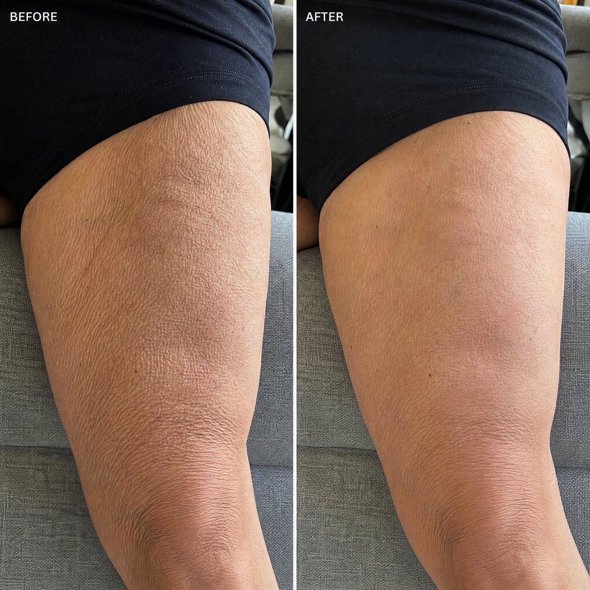 Before and after — firmer smoother thigh skin